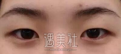 扇形双眼皮