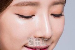 北京韩式隆鼻价格贵吗?做之前有必要了解下收费标准哟~ width=