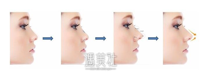 韩式隆鼻价格