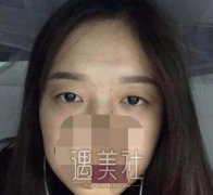 二附院李钢双眼皮案例：单眼皮和双眼皮差别真的很大~ width=