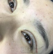平煤总医院割双眼皮怎么样？有真实案例吗想看看呢～ width=