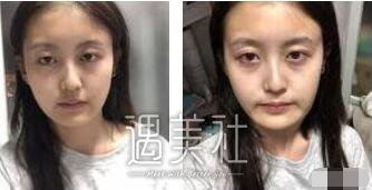 下颌角吸脂照片对比：真的变成瓜子脸了，灰常开森~