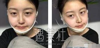 下颌角吸脂照片对比：真的变成瓜子脸了，灰常开森~