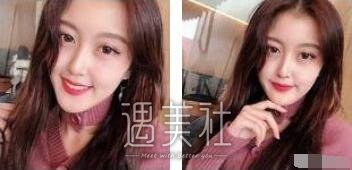 下颌角吸脂照片对比：真的变成瓜子脸了，灰常开森~