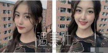 下颌角吸脂照片对比：真的变成瓜子脸了，灰常开森~