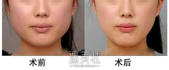 上海吸脂手术大概价格：报价为什么都不一样呢?