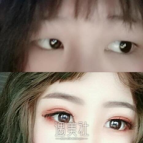北京全切双眼皮多少钱：受哪些因素的影响呢?