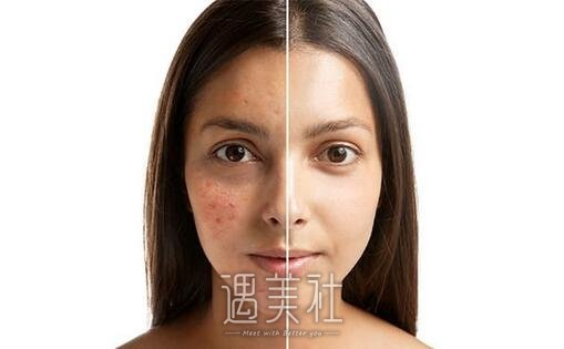 福州冷光子嫩肤果好不好，做几次有果~