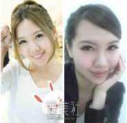 缩鼻翼前后对比照：大鼻头有了解决的方法了~ width=