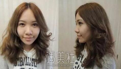 缩鼻翼前后对比照：大鼻头有了解决的方法了~