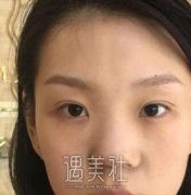 鹏程美容医院隆鼻案例：看来选择鹏程是灰常正确的抉择~ width=