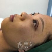 王志军全切双眼皮修复案例：失败不要紧医生要找对~ width=