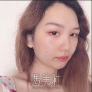 鹏程美容医院割双眼皮案例分享：大大的眼睛心情都好了~ width=