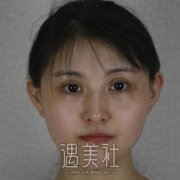 首尔丽格崔荣达颧骨内推手术案例：妈妈说现在的面相不错~ width=