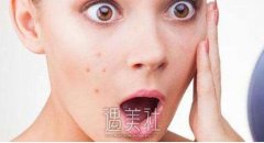 济南激光去痘印一般多少钱，影响价格的因素多不多？ width=