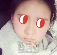 北京仁雁医疗美容怎么样？刚做隆鼻的我想客观评价下~ width=