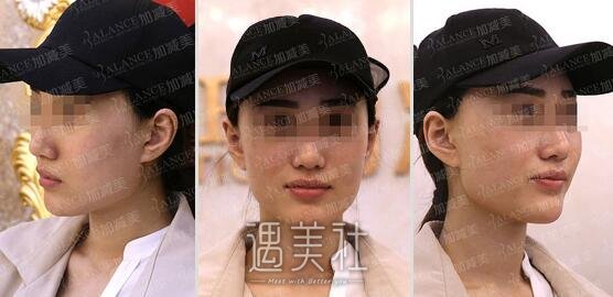 黄寅守,下颌角截骨