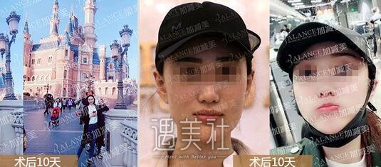 黄寅守,下颌角截骨