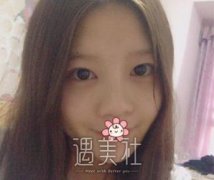 鼻部手术真实恢复期图片：做了颜值提升好几个度～ width=