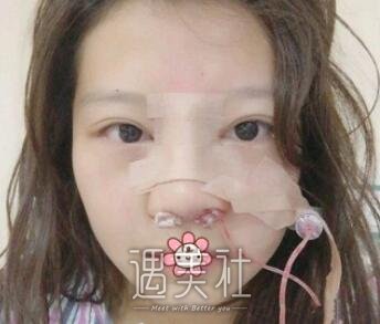 鼻部手术