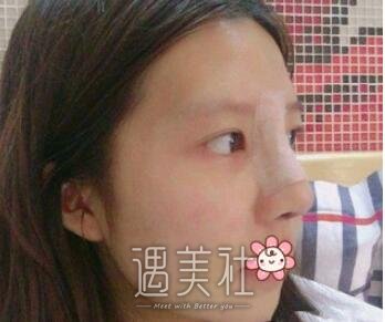 鼻部手术