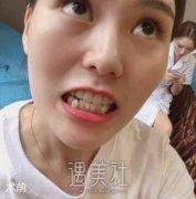 牙齿矫正前后对比果图：微笑成为我的招牌动作～ width=