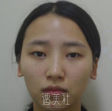 开内眼角