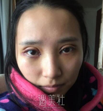 开内眼角