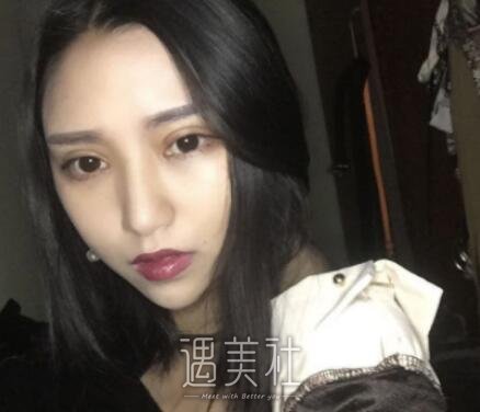 开内眼角