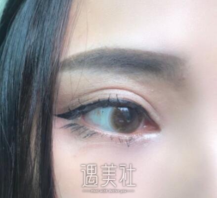 开内眼角