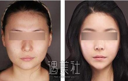 运城面部吸脂修复一般要多少钱?有哪些直接影响因素呢?