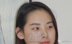 找刘仁生医生割双眼皮三个月了，恢复得和天生的没啥区别了~ width=