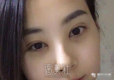 找刘仁生医生割双眼皮三个月了，恢复得和天生的没啥区别了~