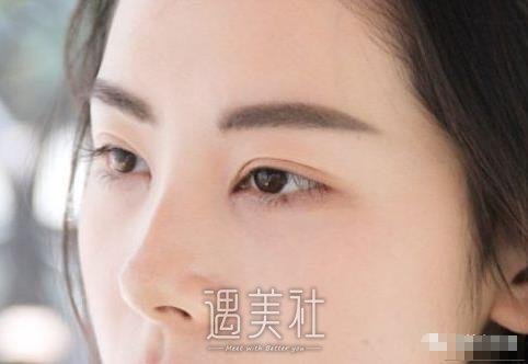 找刘仁生医生割双眼皮三个月了，恢复得和天生的没啥区别了~