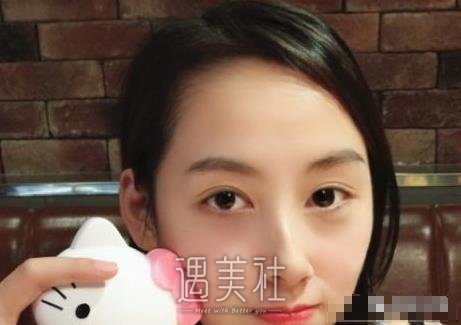 找刘仁生医生割双眼皮三个月了，恢复得和天生的没啥区别了~