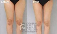 枣庄水动力溶脂减肥大约需要多少钱?多少预算比较合适? width=