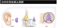 淄博做自体软骨隆鼻术要花多少钱?听说自体的会有点贵 width=