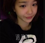 开内眼角恢复过程图片|开内眼角案例记录详细恢复过程~ width=