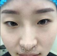 开眼角果明X吗?开眼角真实案例或许能很好展现了哦~ width=