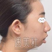 首尔丽格崔荣达凸嘴矫正案例：出门终于不用戴个口罩了~ width=