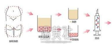 自体脂肪填充下眼睑