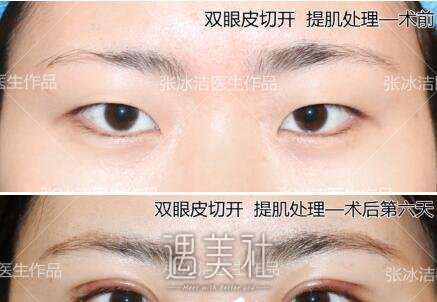 双眼皮预约张冰洁