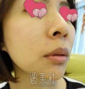 复合彩光除皱的果如何？这则复合彩光除皱案例能说明~ width=