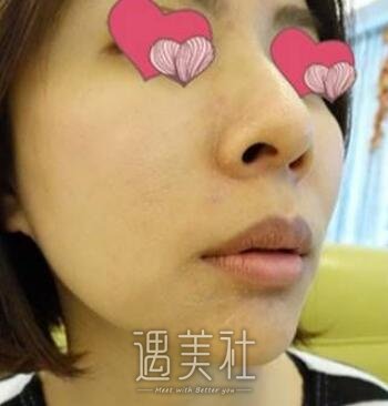 复合彩光除皱