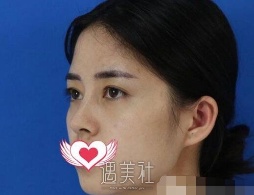 玻尿酸丰面颊