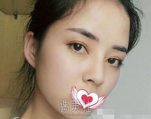 玻尿酸丰面颊