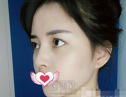 玻尿酸丰面颊