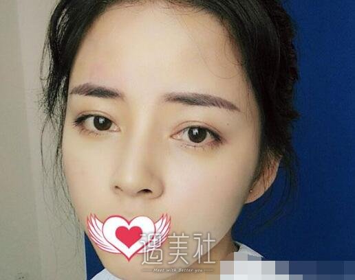 玻尿酸丰面颊