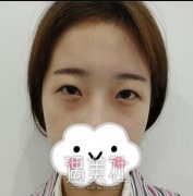 邹志明医生给我做的双眼皮，果比我预想的好太多了~ width=