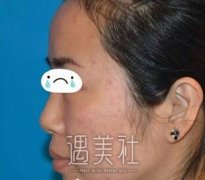 微针去痘坑果怎么样？做过微针去痘坑的我有发言权呢~ width=